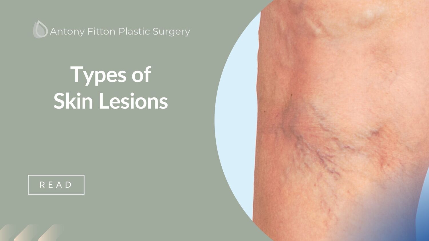 Types of Skin Lesions | Antony Fitton Plastic Surgery Plymouth & Truro