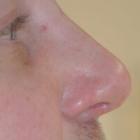 Antony Fitton nose reshaping | Plymouth
