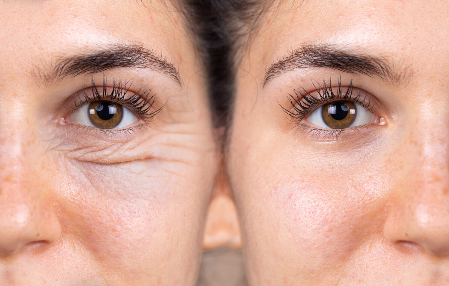 Blepharoplasty or rejuvenate my eyelids