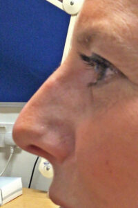Antony Fitton nose reshaping | Rhinoplasty |Plymouth