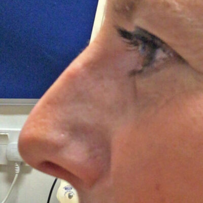 Antony Fitton nose reshaping | Rhinoplasty |Plymouth