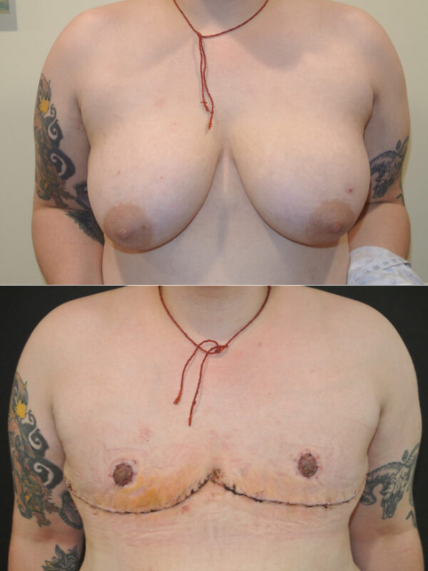 Antony Fitton Female to Male Chest Reconstruction | Plymouth