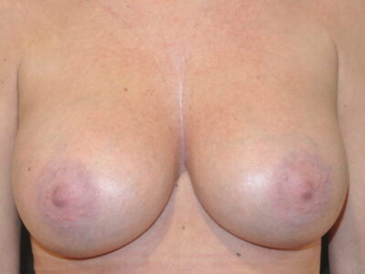 Breast Enlargement | Antony Fitton Plastic Surgery | Plymouth