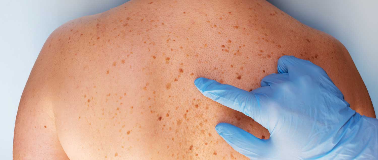 Skin cancer surgery | Antony Fitton Plastic Surgery