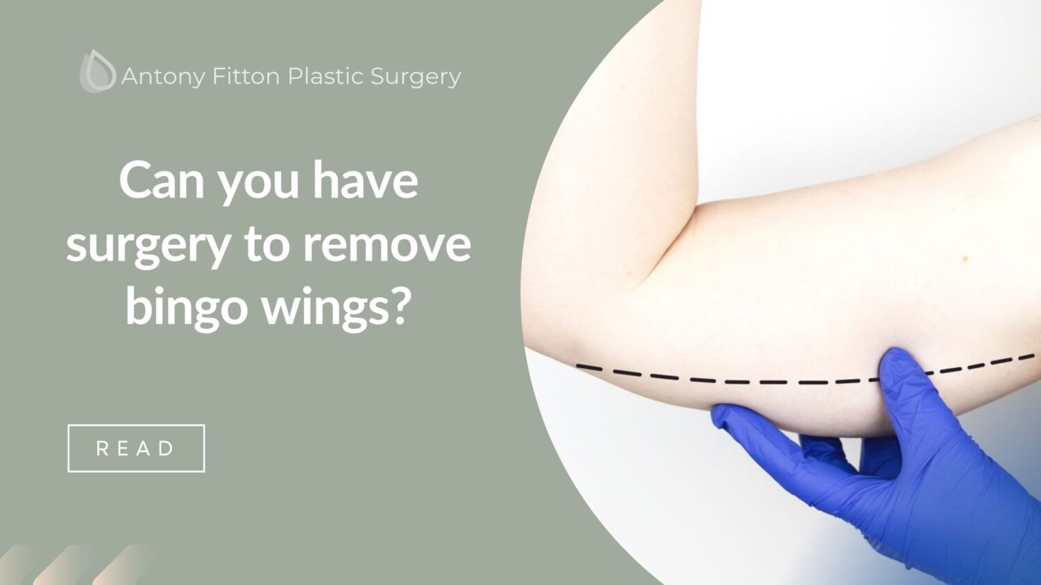 Can you have surgery to remove bingo wings? | Antony Fitton plastic Surgery Plymouth & Truro