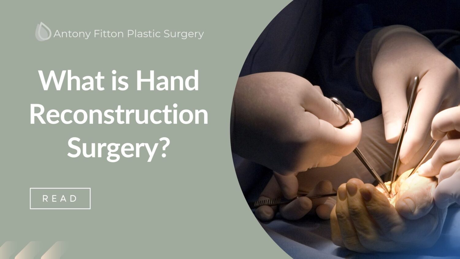 Hand Reconstruction Surgery? | Antony Fitton Plastic Surgeon Plymouth & Truro