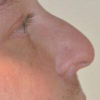Rhinoplasty | Cost | Risks | Recovery | Plymouth & Truro