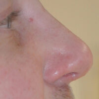Rhinoplasty | Cost | Risks | Recovery | Plymouth & Truro