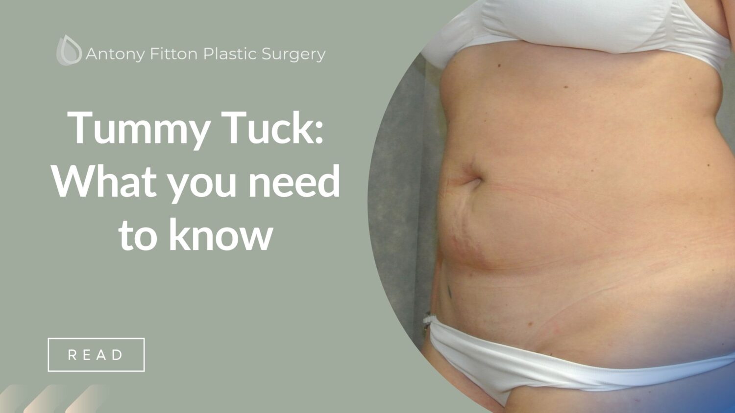Tummy Tuck What you need to know