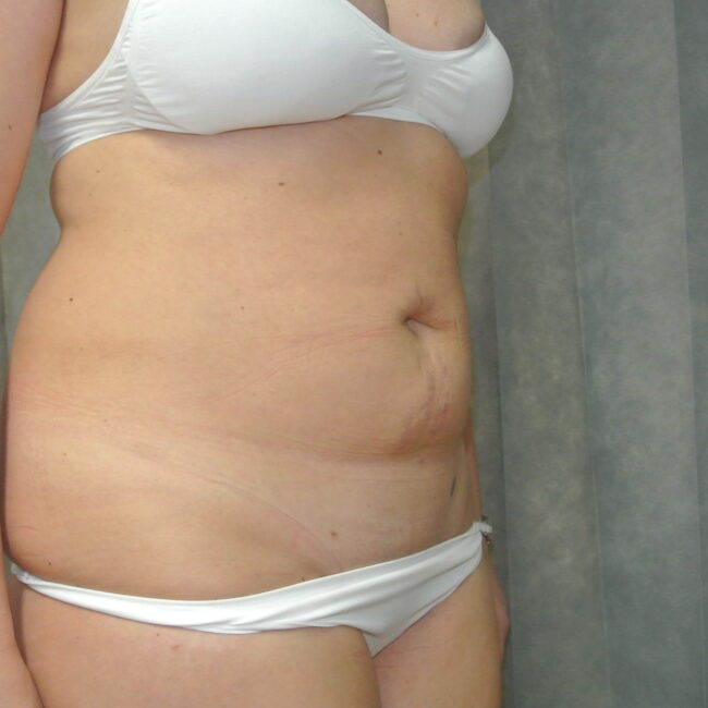 Liposuction | Costs | Risks | Recovery