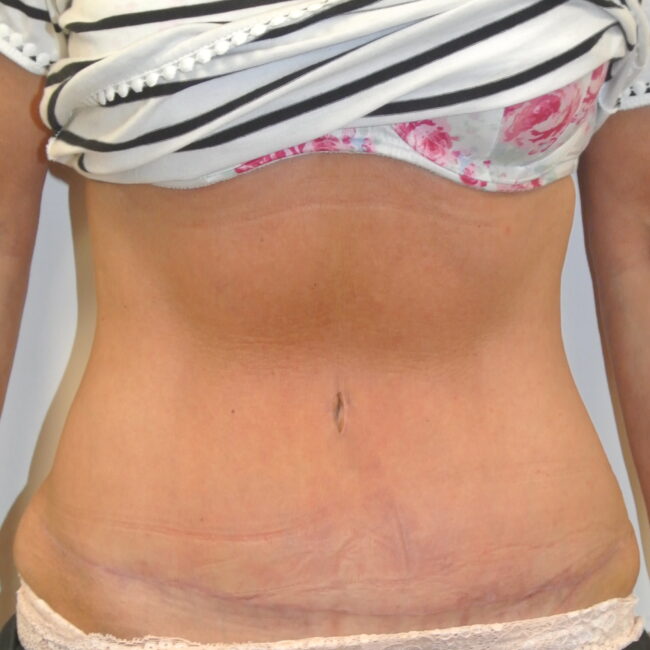 Tummy Tuck costs, risks, recovery