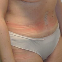 Liposuction | Costs | Risks | Recovery