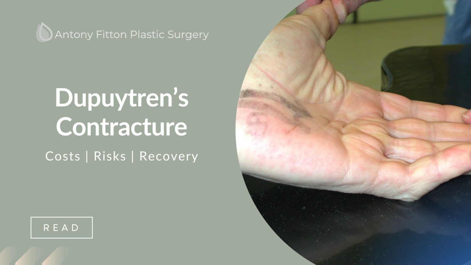 Dupuytren’s Contracture | Antony Fitton | Plastic Surgery Plymouth & Truro