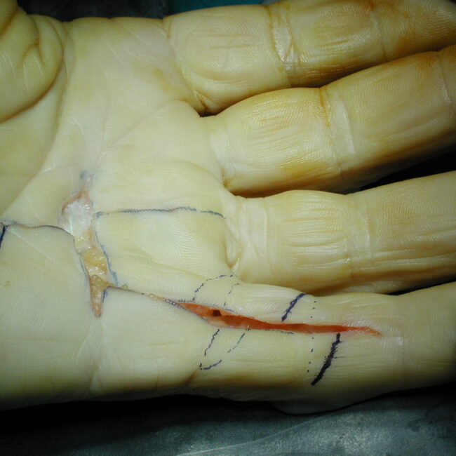 Hand Reconstruction Surgery | Costs | Risks | Recovery