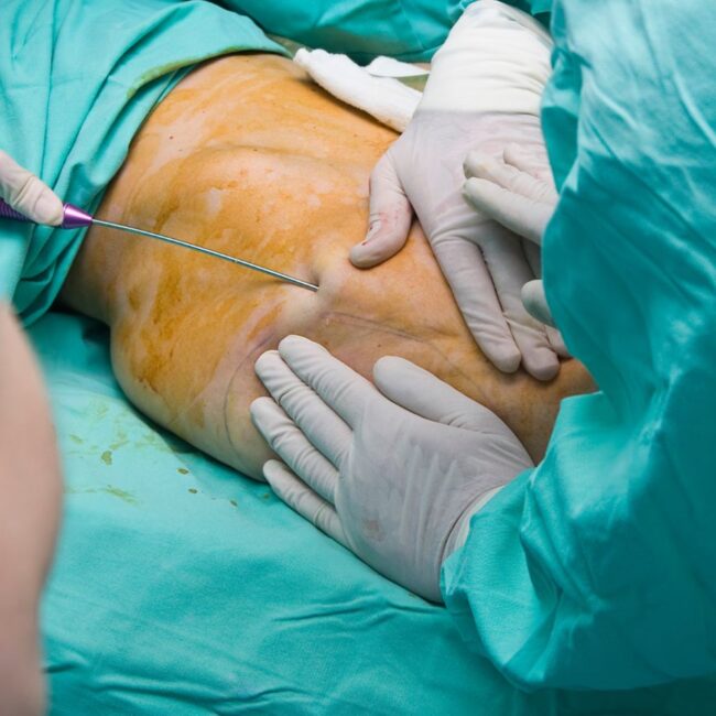 Liposuction Costs | Risks | Recovery Antony Fitton Plastic Surgery Plymouth & Truro