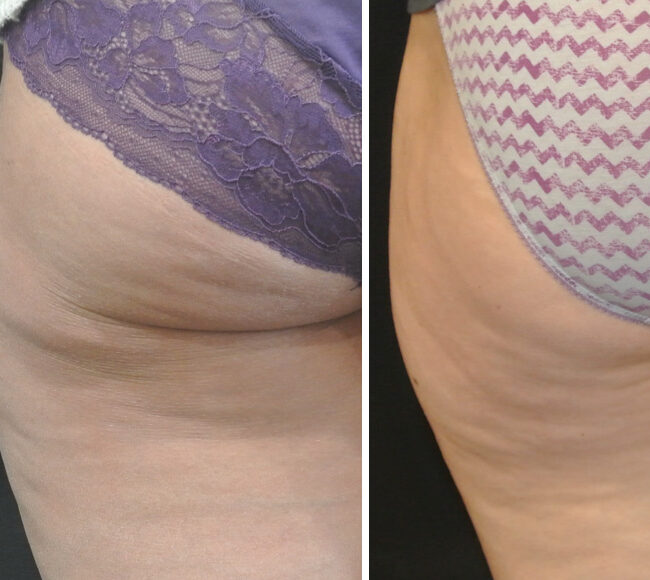 Liposuction | Costs | Risks | Recovery