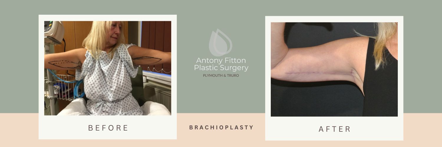 Brachioplasty, Arm Lift or Bingo Wing Removal | Antony Fitton Plastic Surgery | Plymouth and Truro