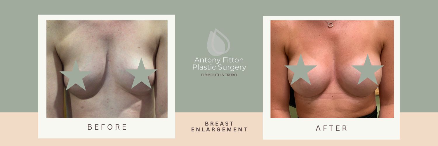 At Antony Fitton Plastic Surgery, we understand that small or uneven breasts can cause anxiety. Breast enlargement is a solution that will increase your breast size and shape, improve symmetry, and boost your self-confidence. | Antony Fitton Plastic Surgery | Plymouth and Truro