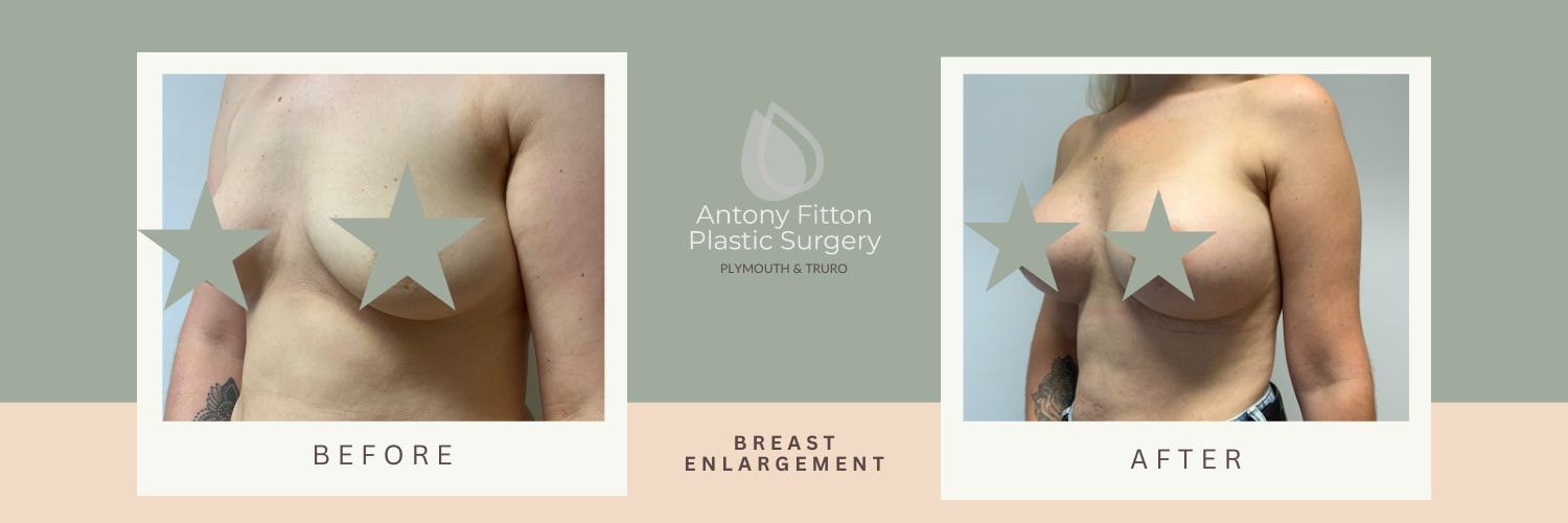 | Antony Fitton Plastic Surgery | Plymouth and Truro