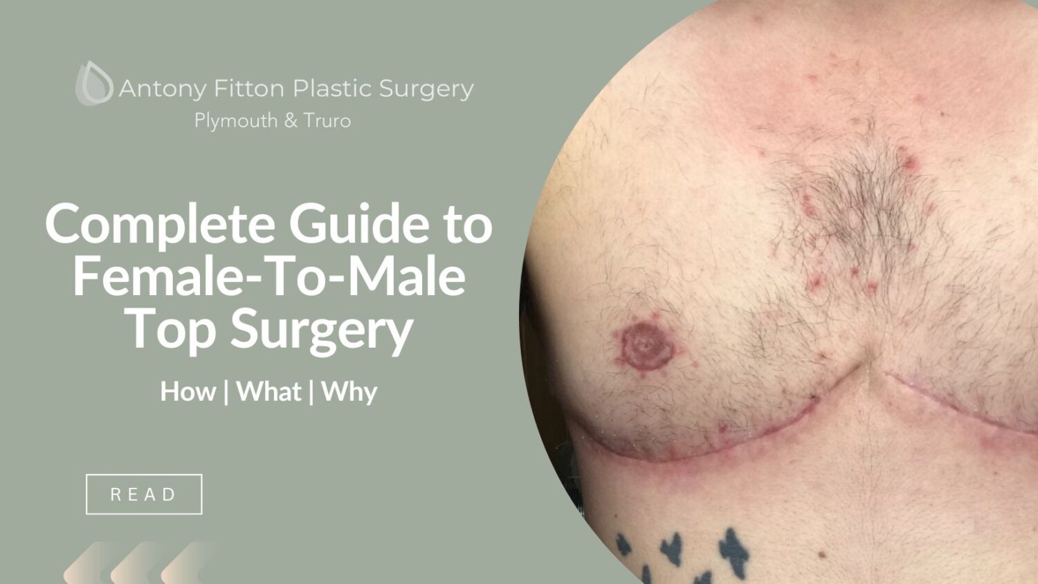 Complete Guide to Female-To-Male Top Surgery | Antony Fitton Plastic Surgery | Plymouth and Truro