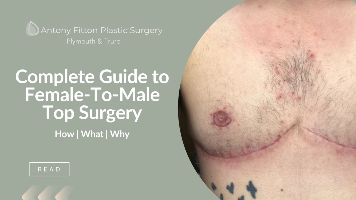 Double Incision Free Nipple Graft Top Surgery in a Gender Non-Binary  Individual: Long Term Results