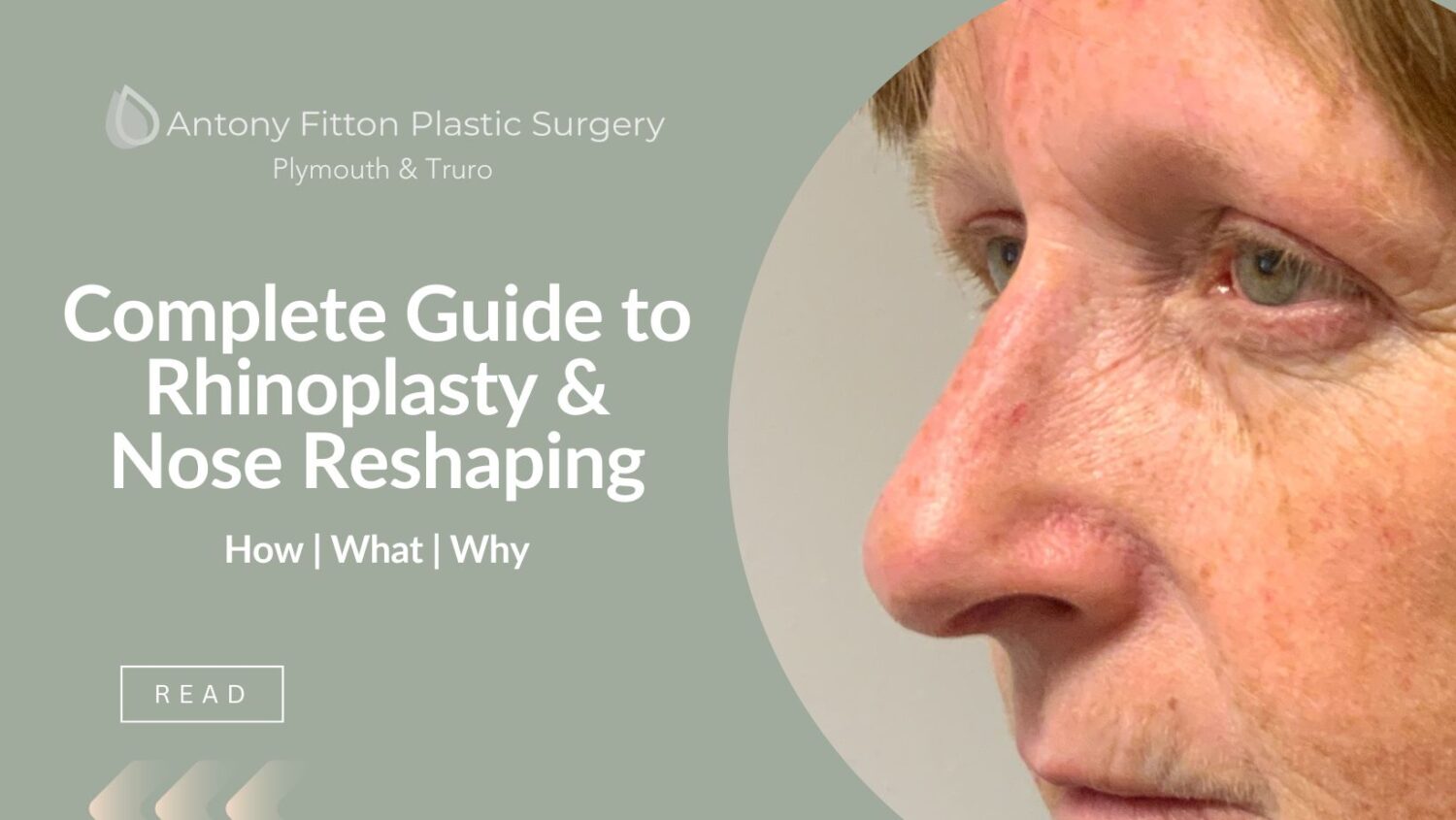 Correcting an Upturned Nasal Tip - Dr. Vincent Marin - Marin Aesthetics