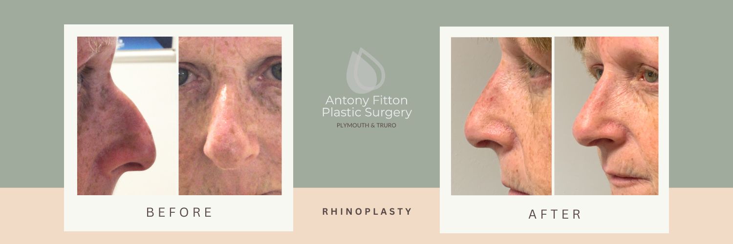 Nose Reshaping, Nose Job, or Rhinoplasty | Antony Fitton Plastic Surgery | Plymouth and Truro