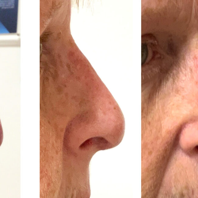 Download your Complete Guide to Nose Reshaping, covering various aspects of the procedure, preparation, recovery, and post-operative care | Antony Fitton Plastic Surgery | Plymouth and Truro