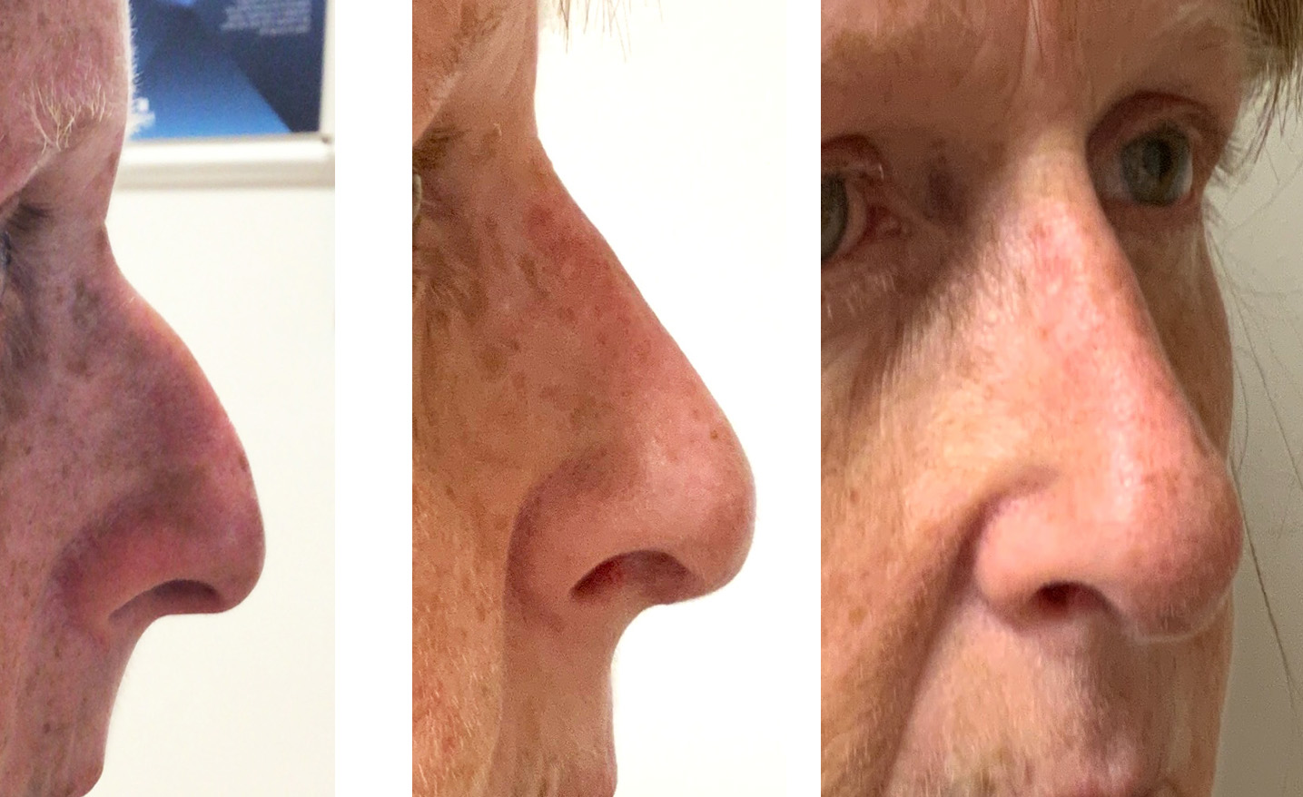 Download your Complete Guide to Nose Reshaping, covering various aspects of the procedure, preparation, recovery, and post-operative care | Antony Fitton Plastic Surgery | Plymouth and Truro
