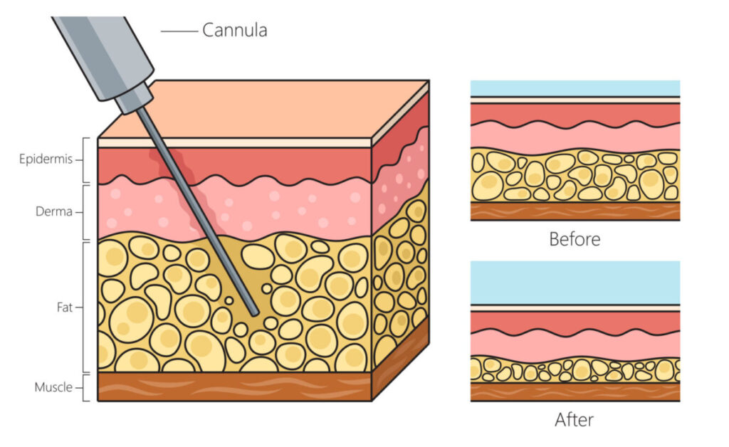 How to create the look you desire with Liposuction | Antony Fitton Plastic Surgery | Plymouth and Truro