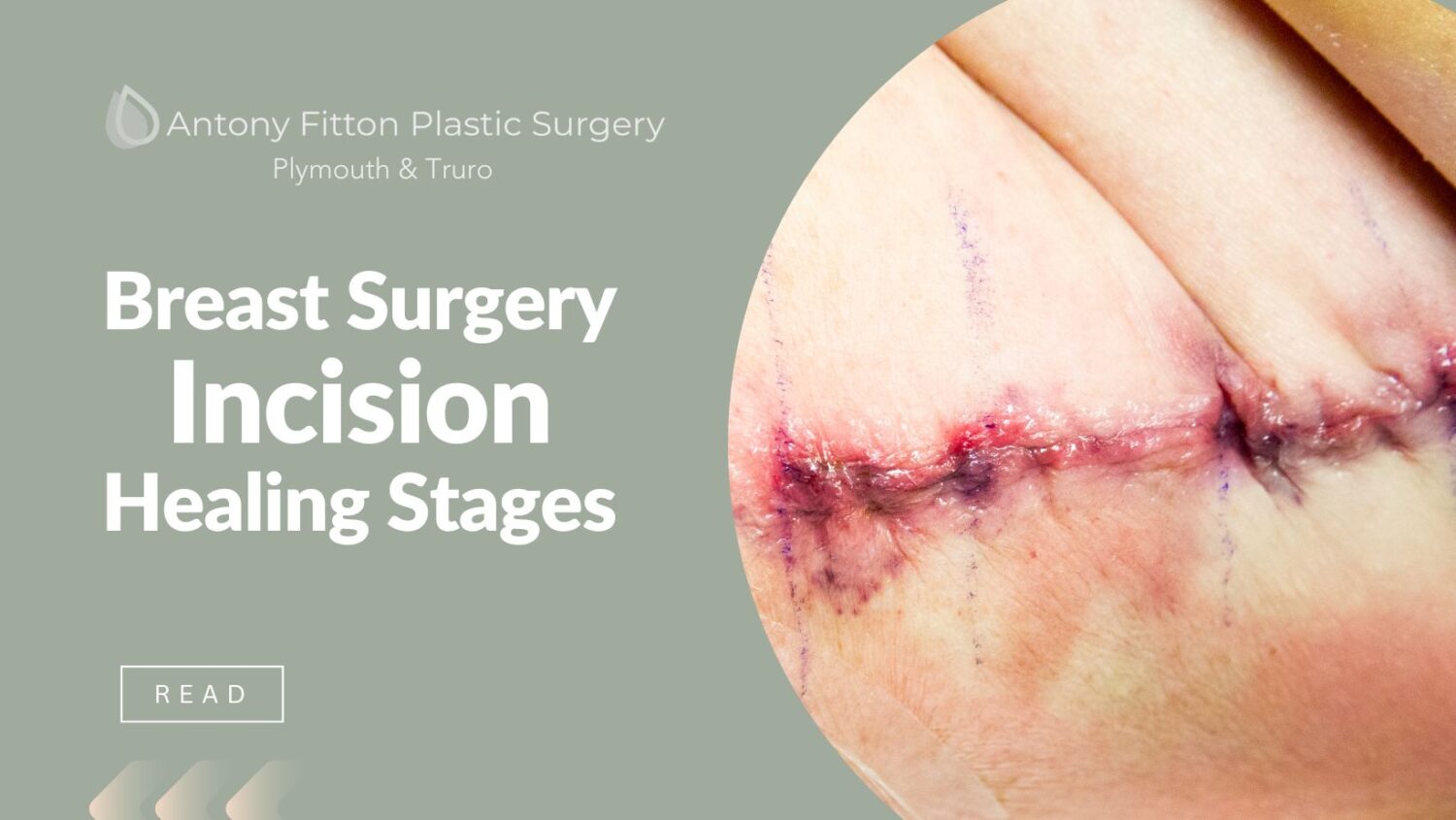 Breast Surgery Incision Healing Stages | Antony Fitton Plastic Surgery