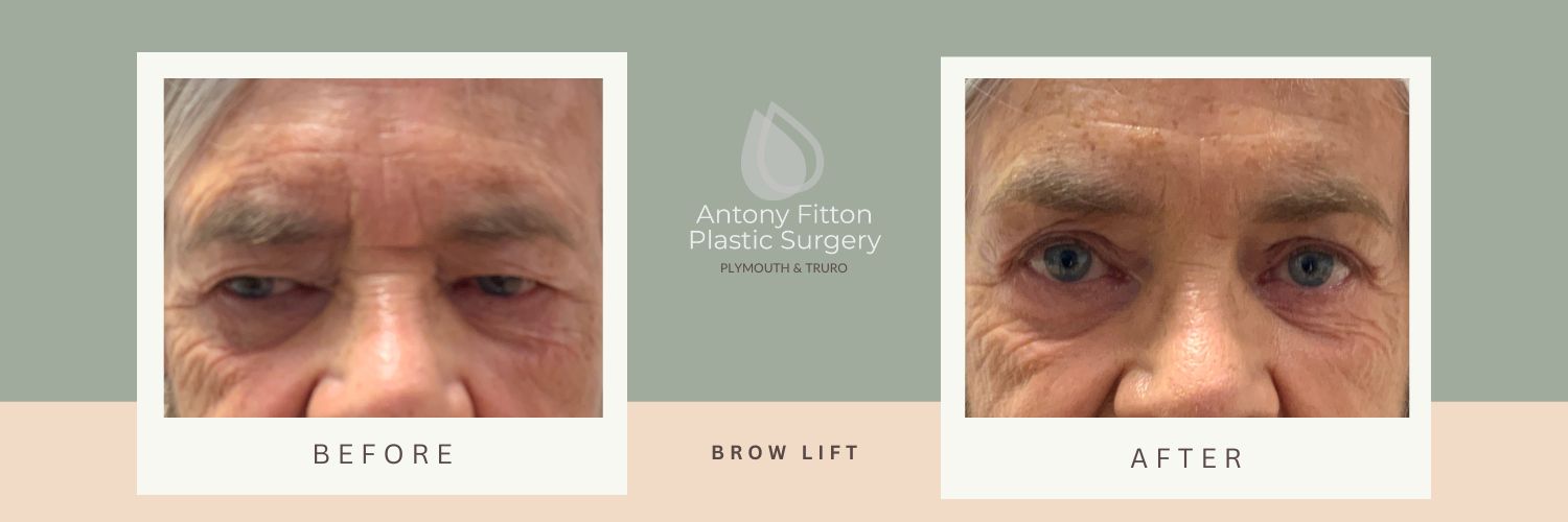 What Is A Brow Lift? A brow lift, also known as a forehead lift, is a surgical procedure aimed at lifting and tightening the skin and muscles of the forehead and brow area. It addresses sagging brows, forehead wrinkles, and hooded eyelids by repositioning the underlying tissues and removing excess skin. During a brow lift, incisions are typically made either along the hairline or within the natural creases of the forehead. The surgeon then lifts the skin, adjusts the underlying muscles, and removes any surplus tissue before closing the incisions.