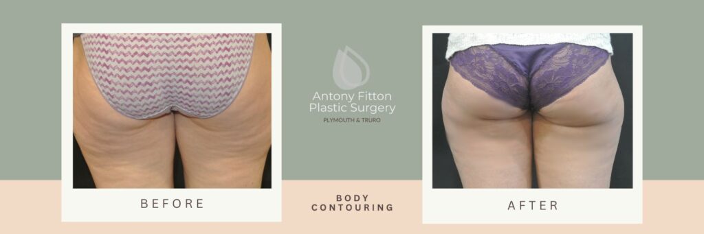 How to create the look you desire with Liposuction | Antony Fitton Plastic Surgery | Plymouth and Truro