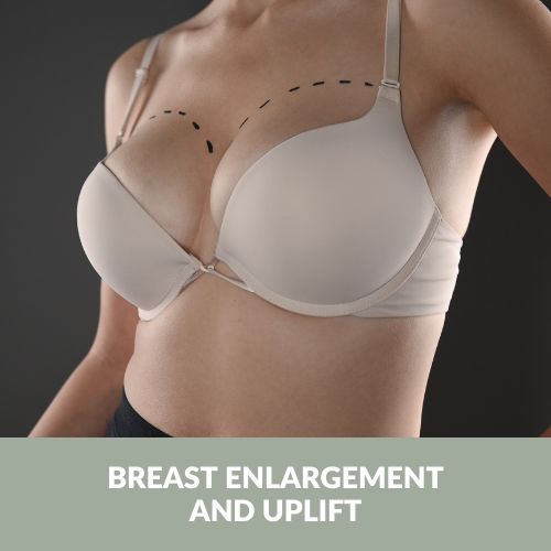 Breast enlargement with uplift is a surgical procedure that uses implants to increase the size and alter the shape of the breasts | Antony Fitton Plastic Surgery | Plymouth and Truro