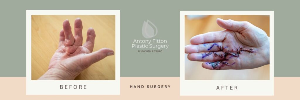 Hand surgery | Antony Fitton Plastic Surgery | Plymouth & Truro
