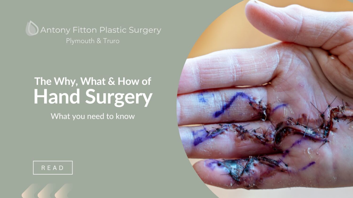 The Why, What & How of Hand Surgery