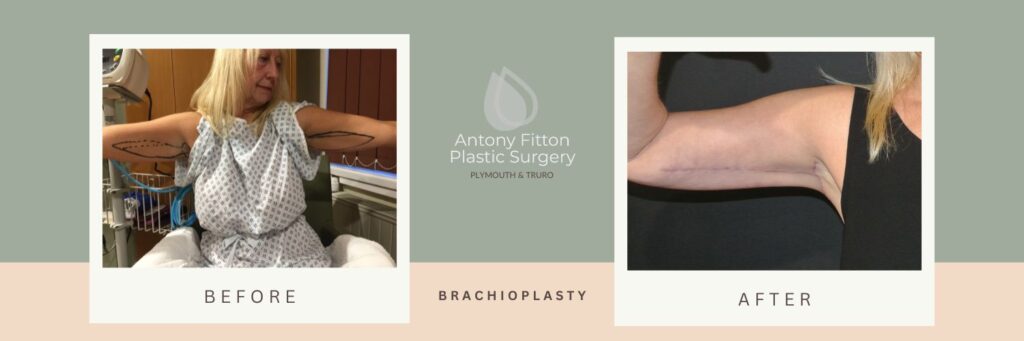 Understanding the Pros and Cons of Bingo Wing Surgery | Antony Fitton Plastic Surgery | Plymouth & Truro