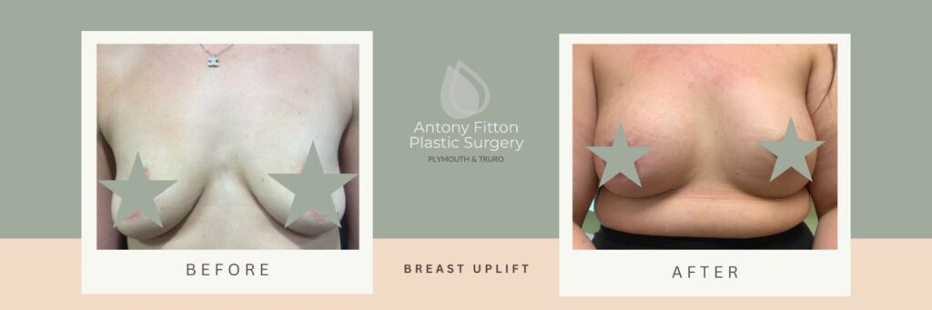 7 Ways to Lift Saggy Breasts (and Boost Your Self-confidence) | Antony Fitton Plastic Surgery | Plymouth & Truro
