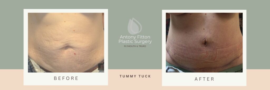 Tummy Tuck before and after | Antony Fitton Plastic Surgery | Plymouth & Truro