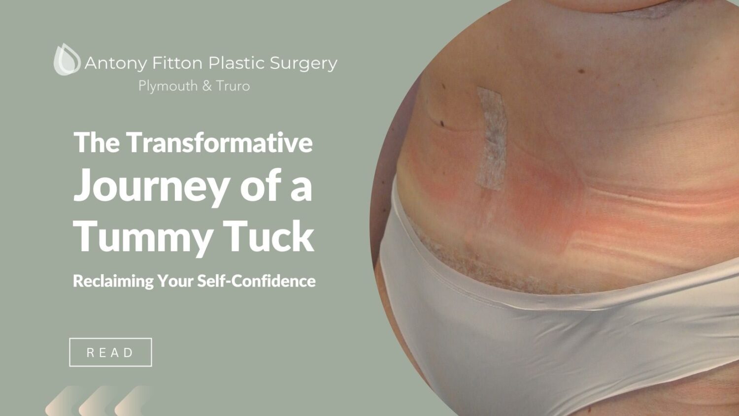 The Transformative Journey of a Tummy Tuck | Antony Fitton Plastic Surgery | Plymouth & Truro