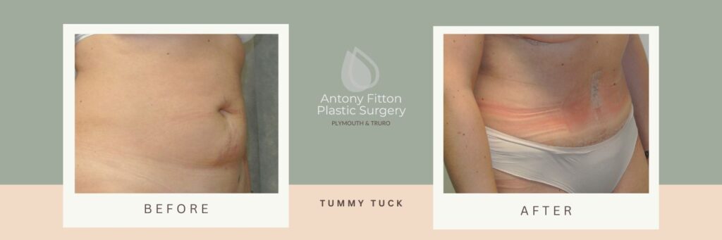 | Antony Fitton Plastic Surgery | Plymouth & Truro