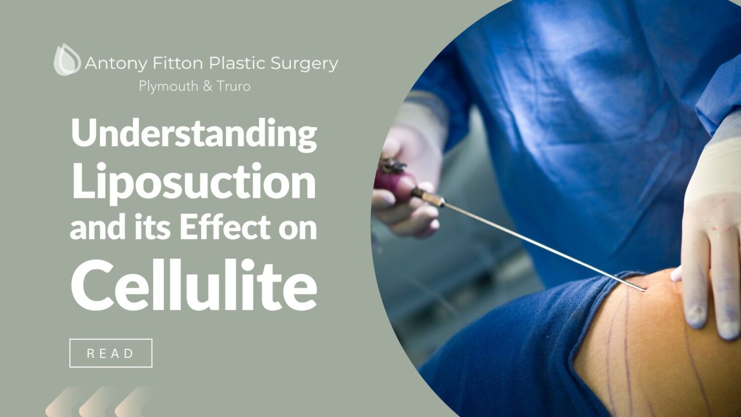 Understanding Liposuction and its Effect on Cellulite | Antony Fitton Plastic Surgery | Plymouth & Truro