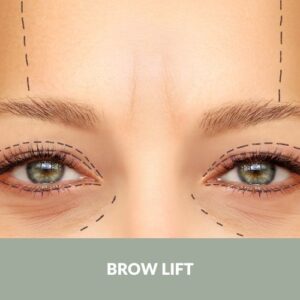 Brow lift