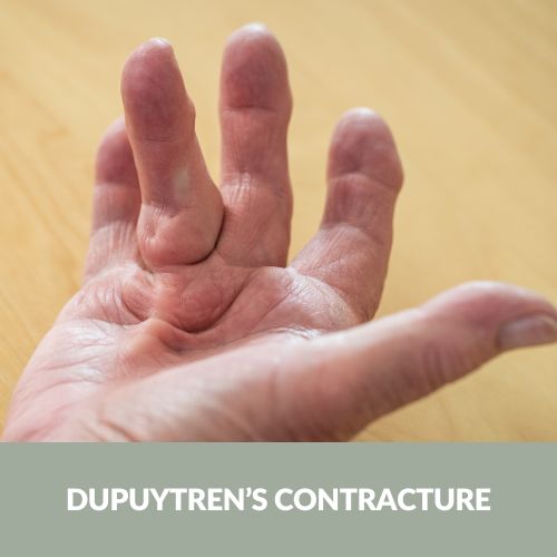 Dupuytren’s Contracture