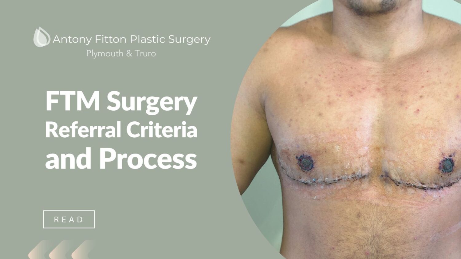 FTM Surgery Referral Criteria and Process