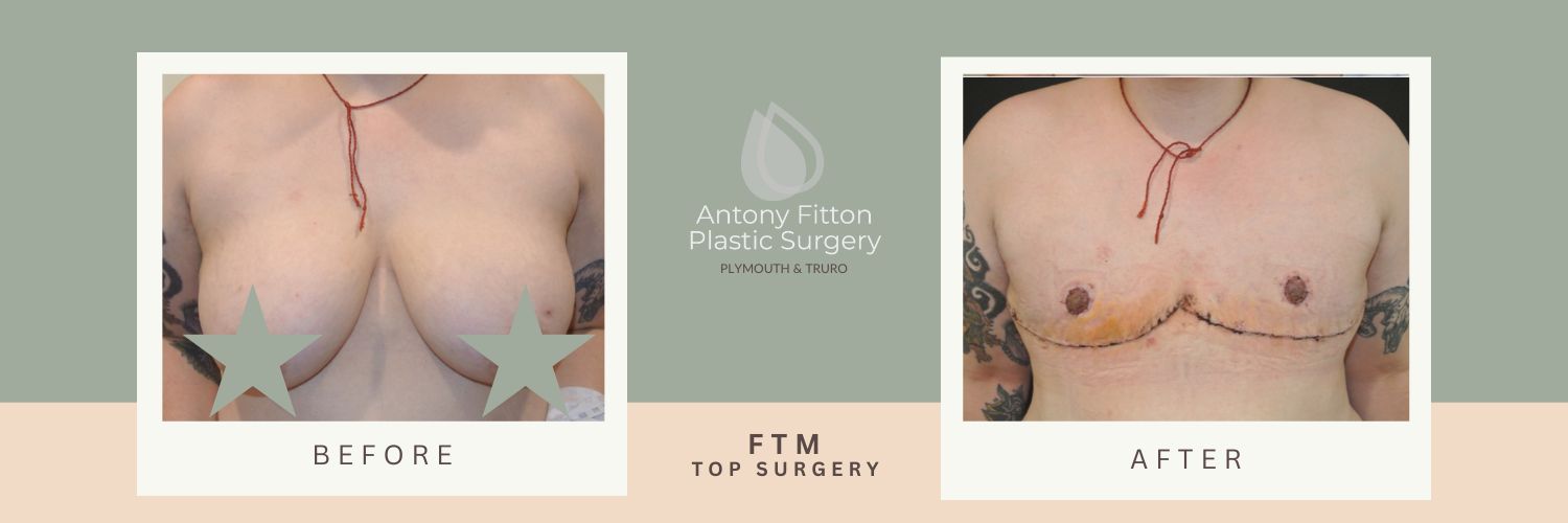 FTM Surgery Referral Criteria and Process