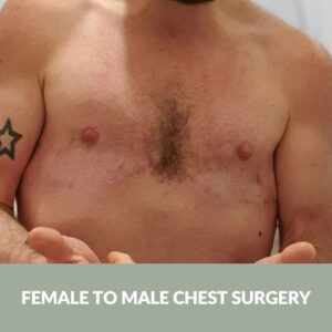 Female to Male Chest Reconstruction _ Non-binary Surgery​