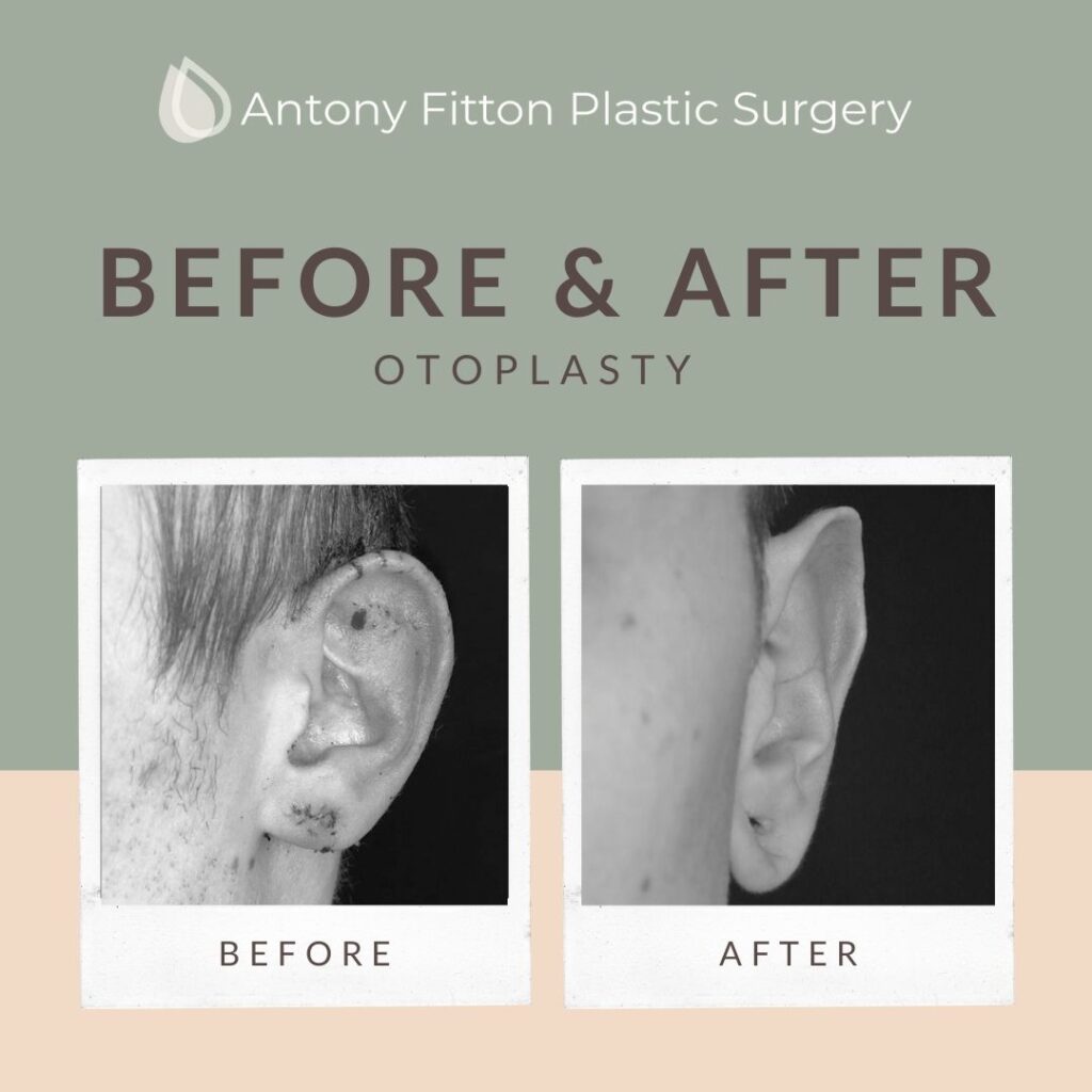 The Benefits of Otoplasty_ Improving Appearance and Confidence