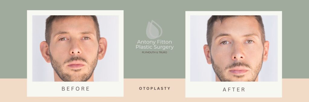 The Benefits of Otoplasty_ Improving Appearance and Confidence