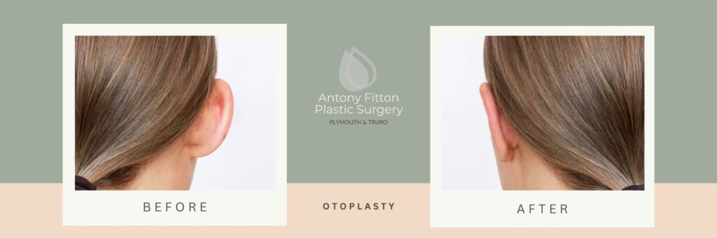 The Benefits of Otoplasty_ Improving Appearance and Confidence